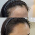 Tricopigmentierung in der Beautypharm-Cham